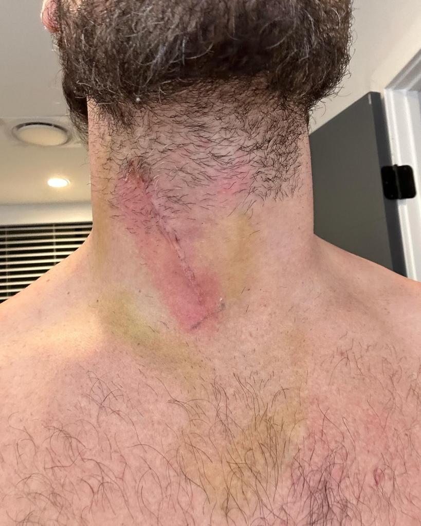 Val Chmerkovskiy's scar on his neck