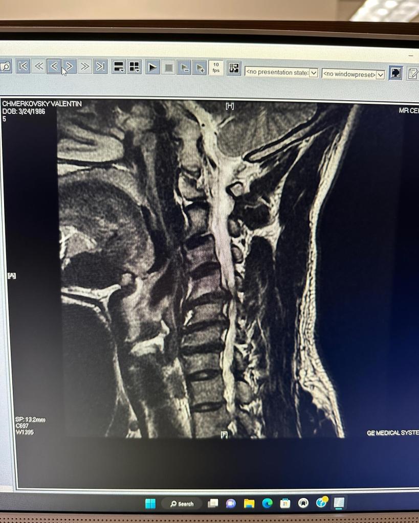 Val Chmerkovskiy's neck X-ray
