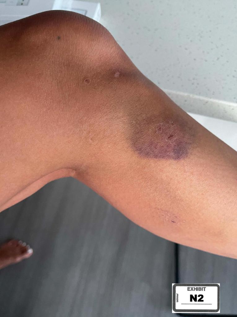 Jeannie Mai's bruises.