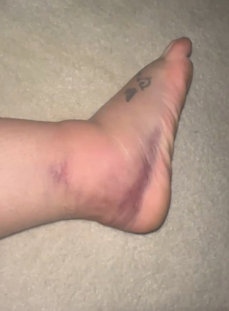 Britney Spears' swollen foot