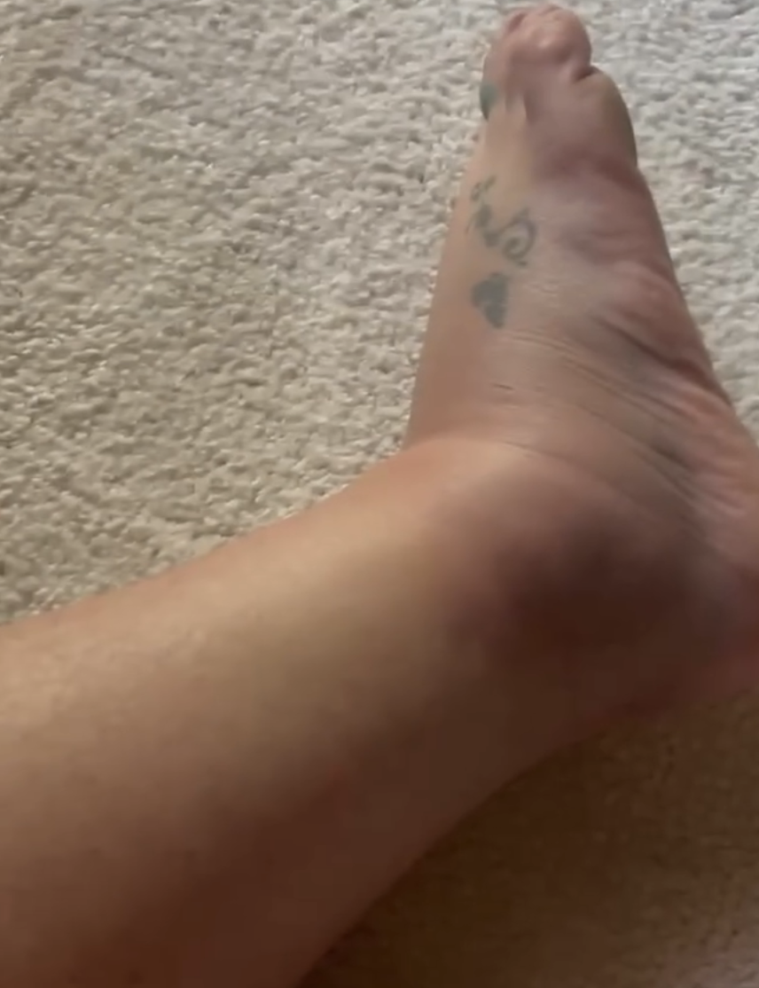 Britney Spears' swollen foot.