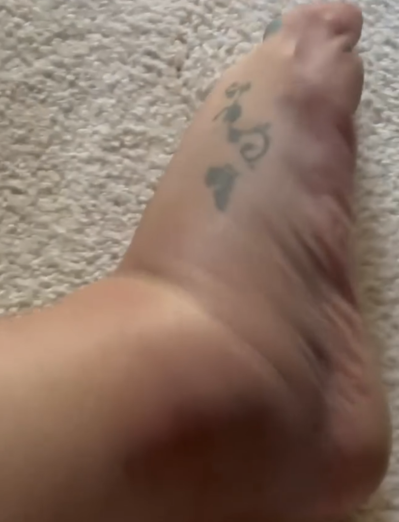 Britney Spears' swollen foot.