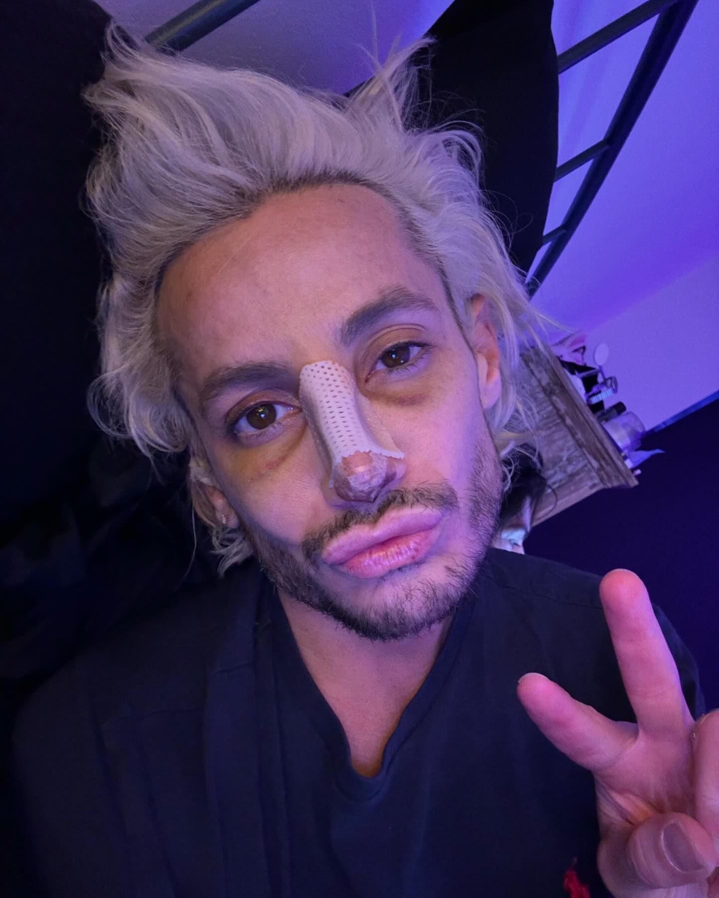 A selfie of Frankie Grande with a cast on his nose