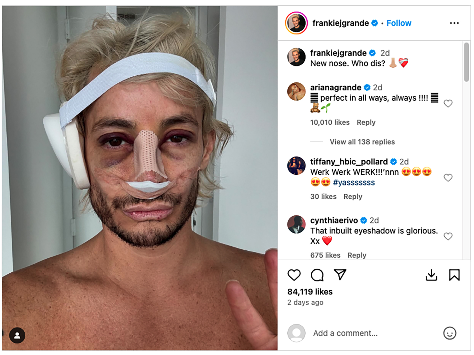 A screenshot of Frankie Grande's Instagram post of his bruised face.