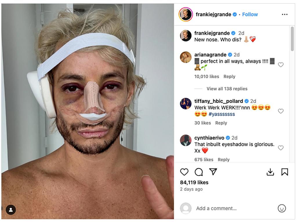 A screenshot of Frankie Grande's Instagram post of his bruised face.