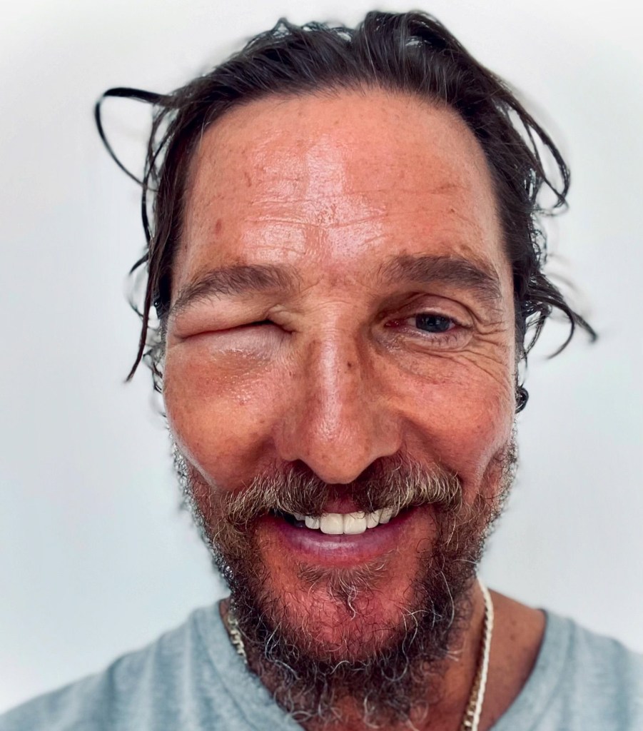  Matthew McConaughey smiling with a swollen eye due to a bee sting