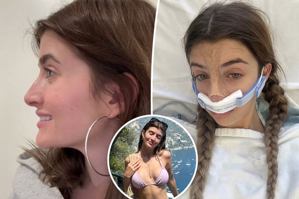 Sami Sheen, 20, gets a nose job 9 months after breast implants: ‘I already feel like a new woman’