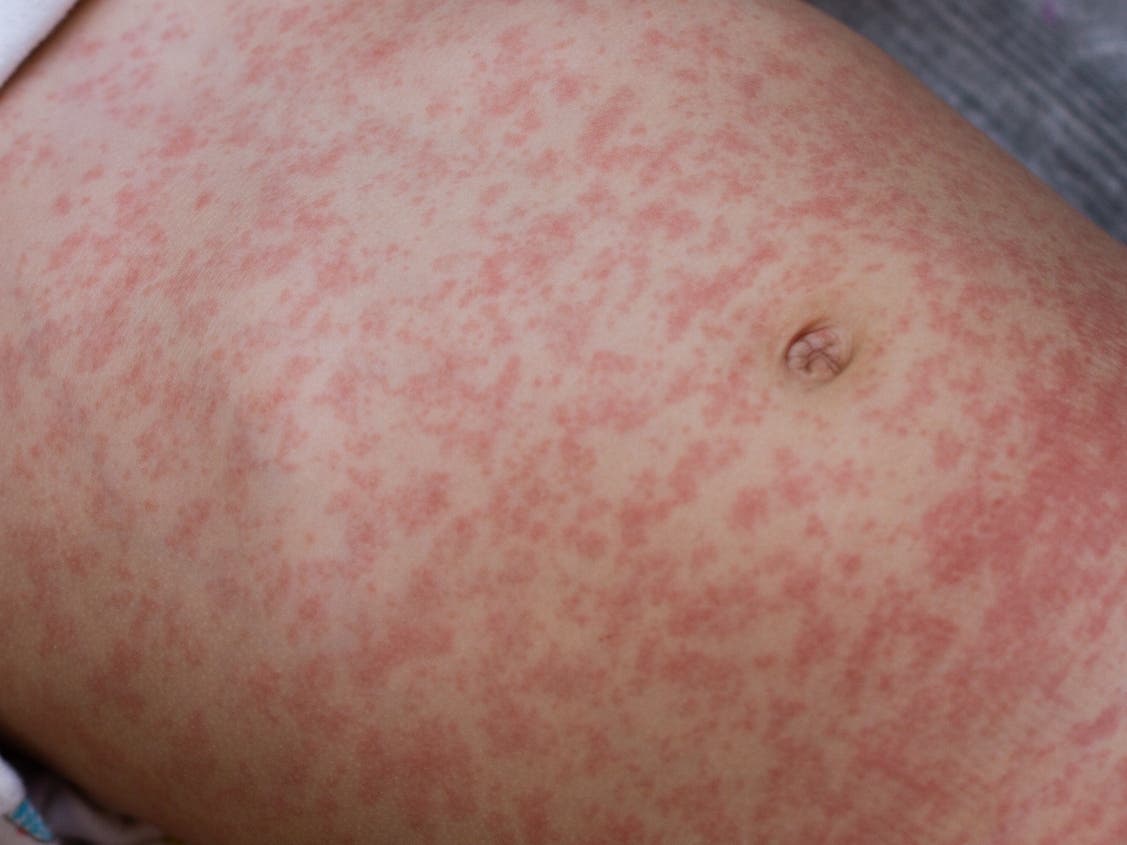 Arlington health officials are warning the public after a person with a confirmed case of measles visited a local grocery store while contagious. 