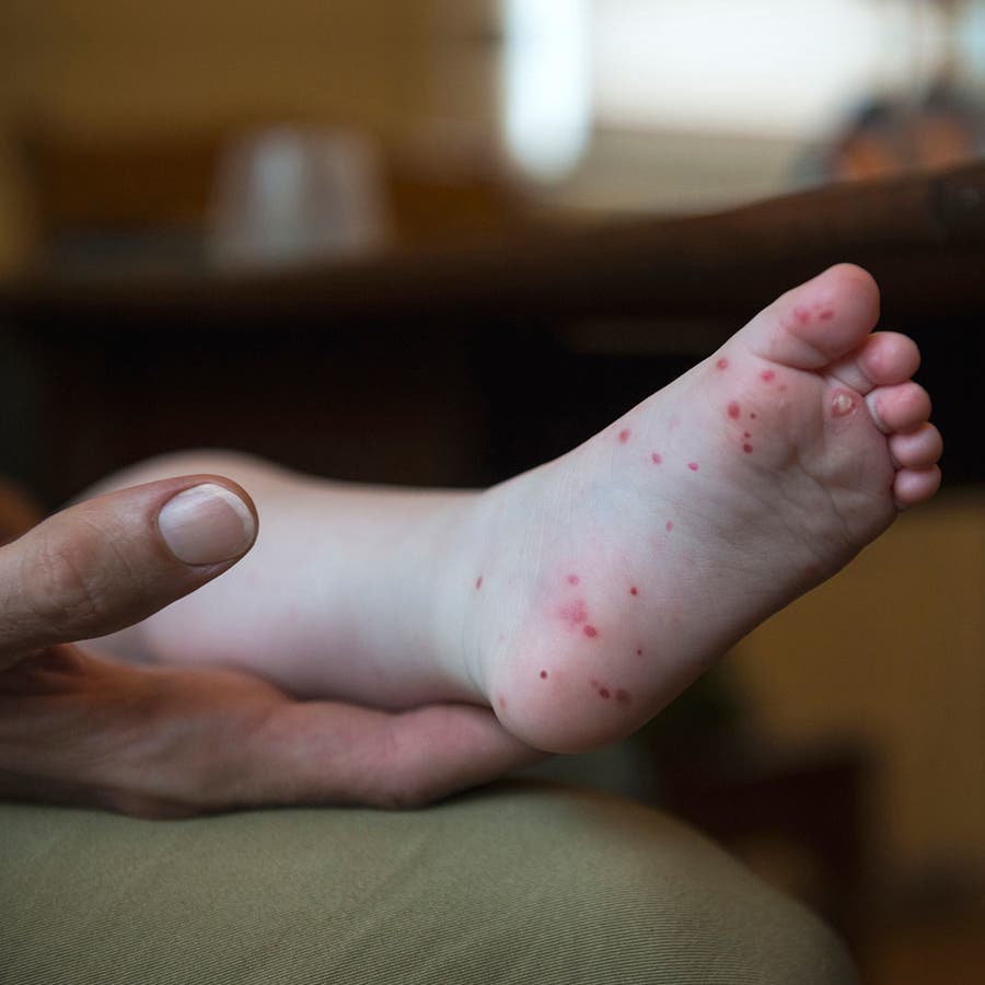 Hand, Foot And Mouth Disease Diagnoses Increase In Midstate: Doc