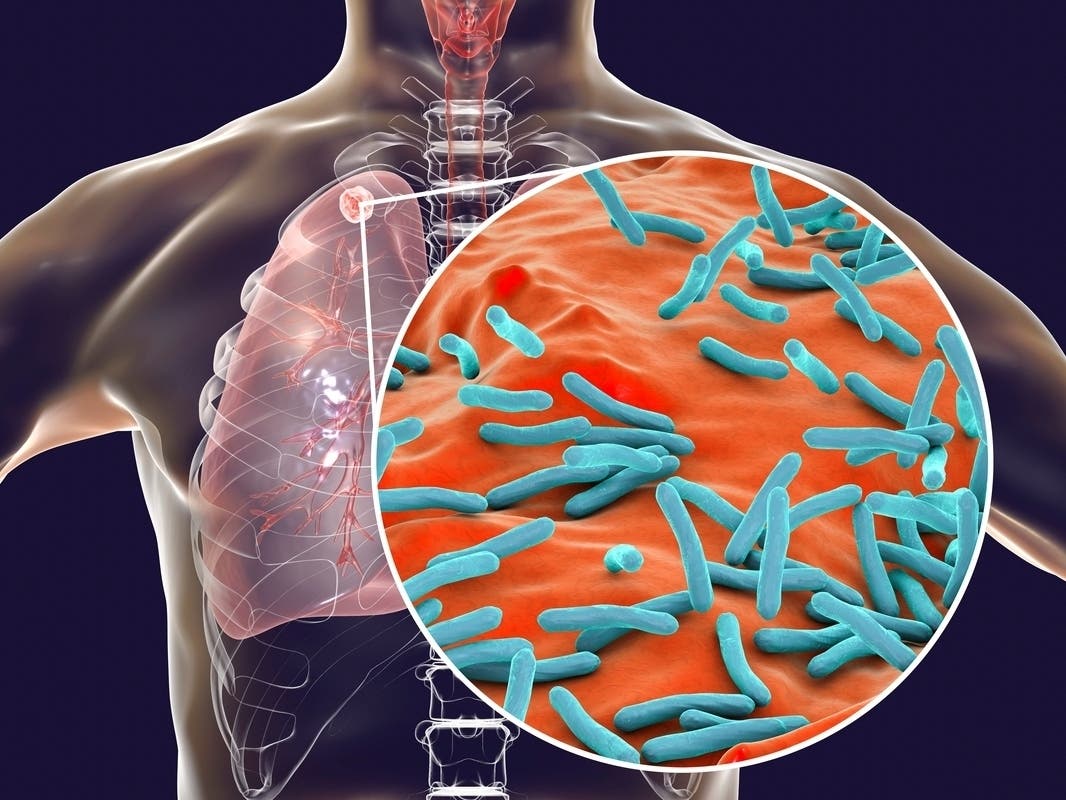 While tuberculosis is spread similarly to a cold or flu, it is not as contagious.
