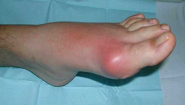 Natural Treatment for Gout