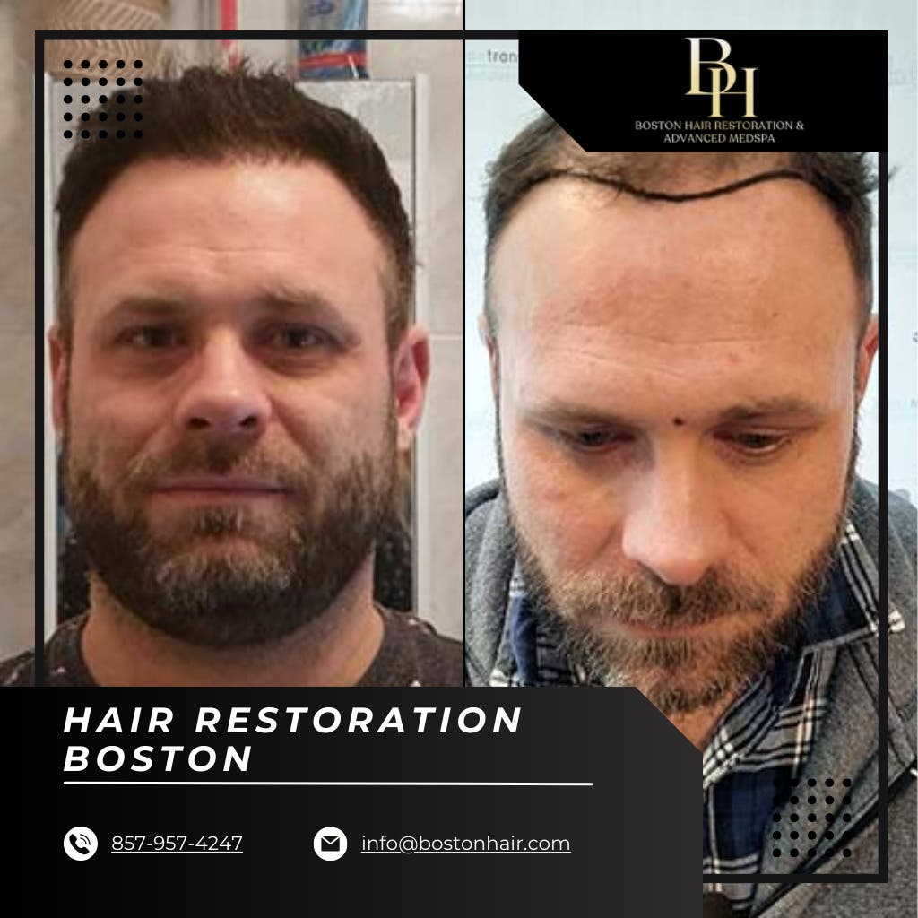 Regain Your confidence: Best Hair Restoration Choices in Boston