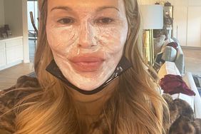 Brandi Glanville Recovering from Snow Peel to Treat Psoriasis Burns: 'Hopefully It Will Help'