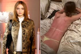  Heidi Klum's Daughter Leni Says She 'Didn't Use Enough Sunscreen' After Brutal Sunburn