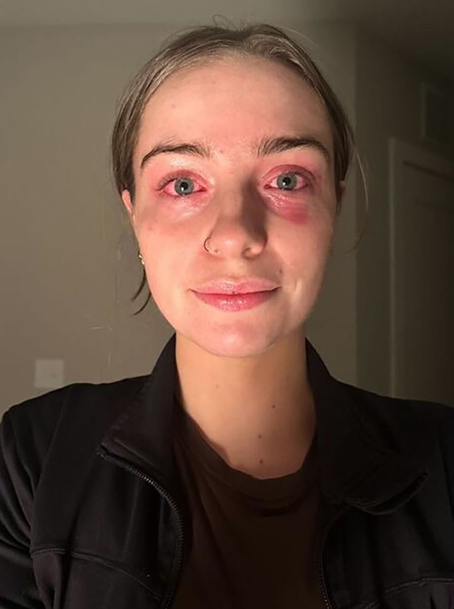 Erin Dunn allergic reaction to earrings.