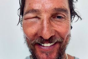 Matthew McConaughey bee sting