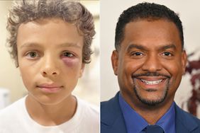 alfonso riberio son black eye