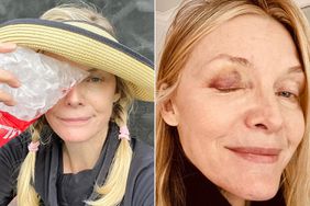 Michelle Pfeiffer black eye from pickleball