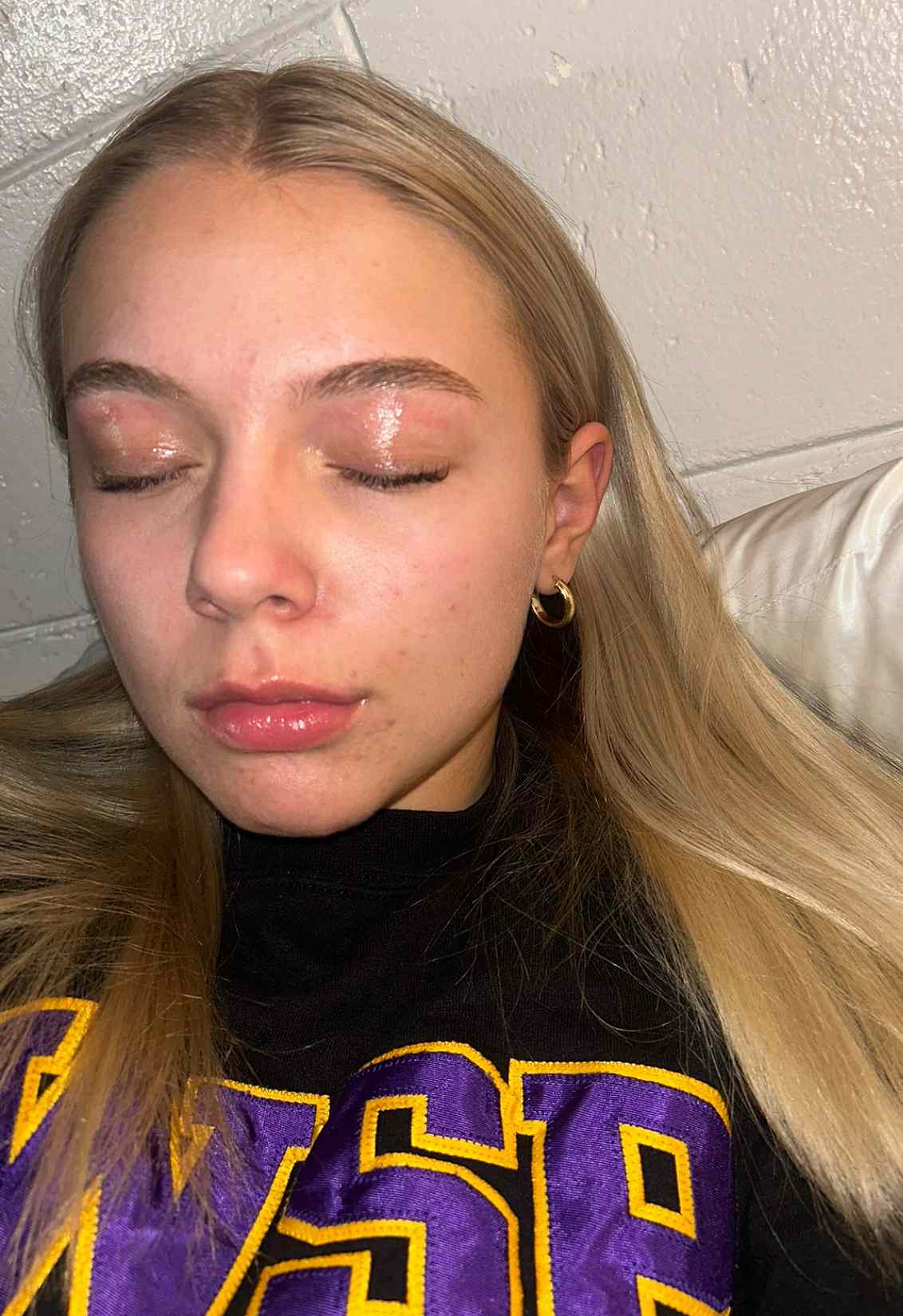 Abbie O'Connor Emerges from Eyebrow Wax with Burns and Discovers Acne Medication Is to Blame
