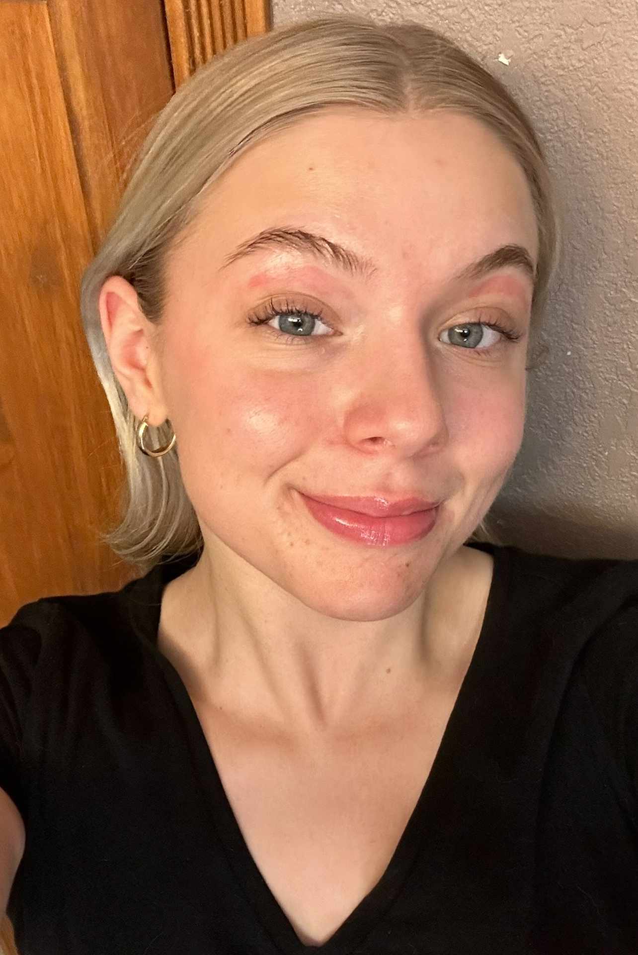 Abbie O'Connor Emerges from Eyebrow Wax with Burns and Discovers Acne Medication Is to Blame