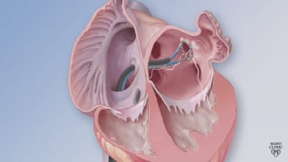 Cardiac ablation for atrial fibrillation