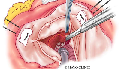 Hypertrophic cardiomyopathy guideline update: Mayo Clinic's perspective