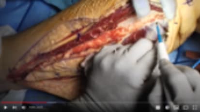 Fibula free flap (free tissue transfer) for mandibular reconstruction