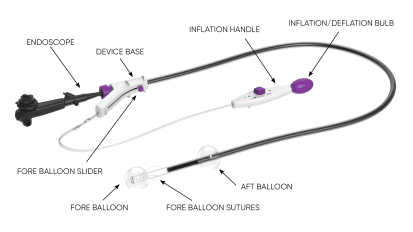 Use of DiLumen in Advanced Therapeutic Procedure for Colostomy Patient