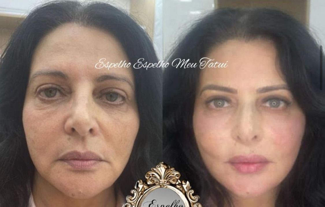 Sônia Lima faz harmonização facial e mostra o antes e o depois — Foto: Instagram
