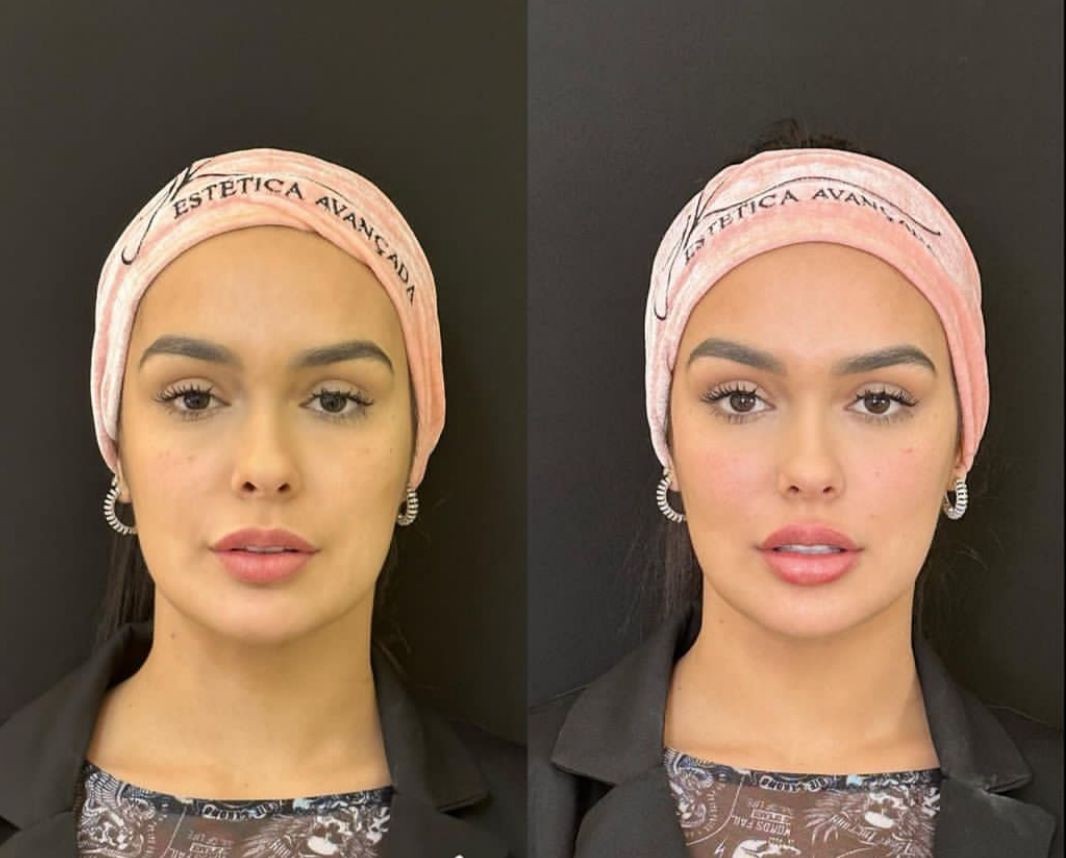 Ex-BBB Larissa Santos faz harmonização facial — Foto: Instagram