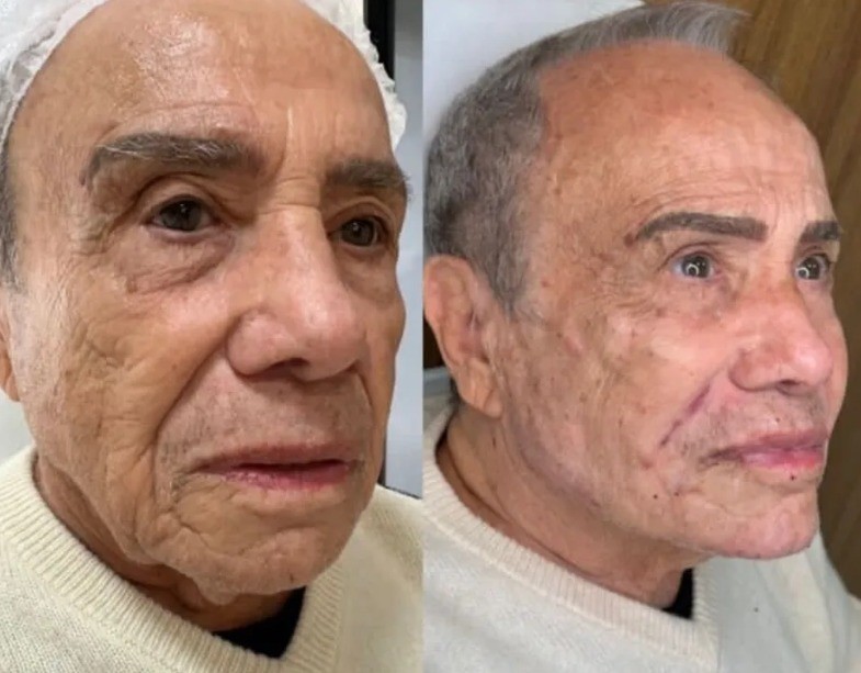 Antes e depois de Stenio Garcia após a harmonização facial — Foto: Divulgação