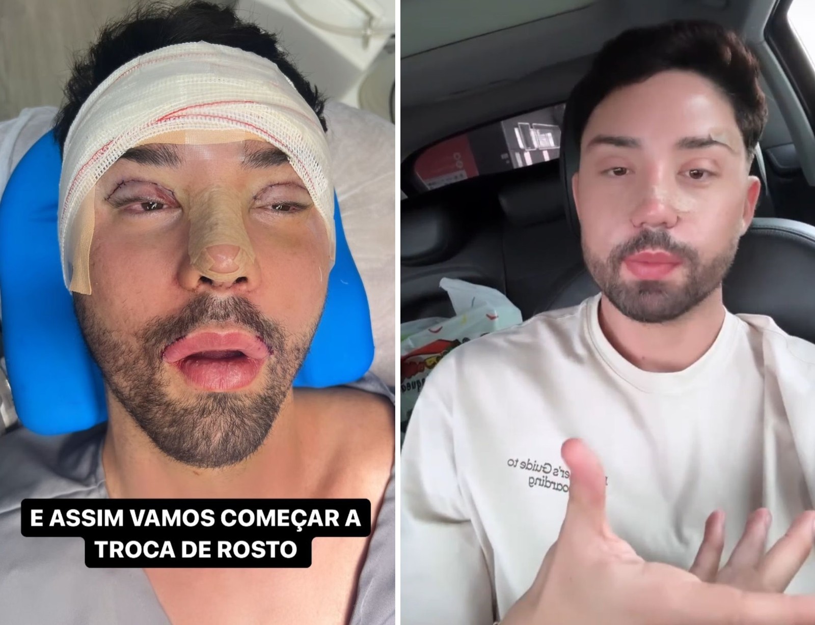 Rico Melquíades desabafa após cinco cirurgias no rosto — Foto: Instagram