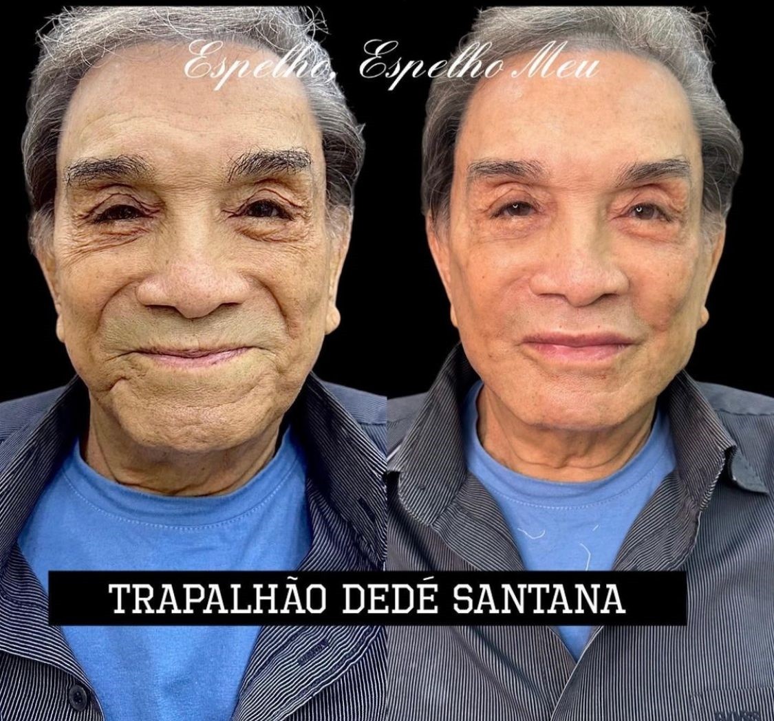 Dedé Santana antes e depois da harmonização facila — Foto: Instagram