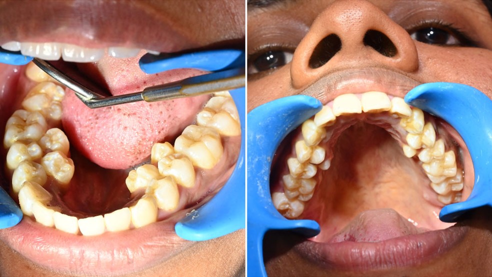 Kalpana Balan bateu o recorde de maior número de dentes na boca de uma pessoa (categoria feminina) — Foto: Guinness World Records / divulgação