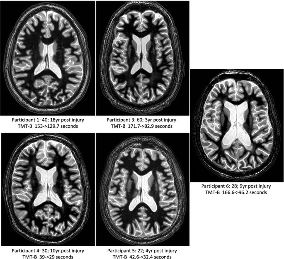 Imagem estrutural de ressonância magnética do cérebro de todos os 5 indivíduos tratados com implantes — Foto: Nicolau D. Schiff et al