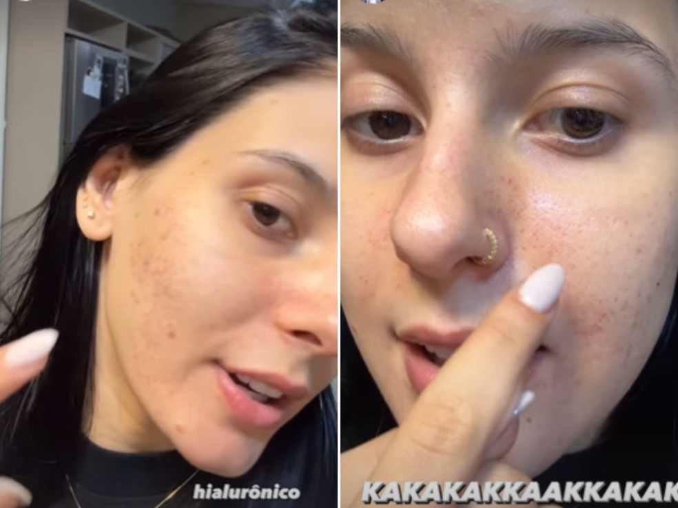 Ana Castela mostra rosto após tratamento contra espinhas — Foto: Reprodução/Instagram