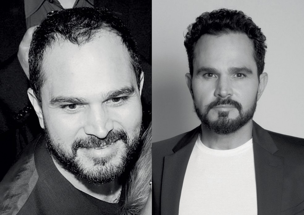O antes e depois do transplante capilar do músico Lucas Lima — Foto: Reprodução