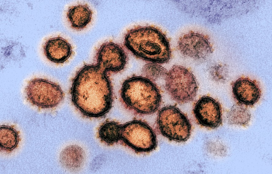 324 / 5.000 Resultados de tradução Resultado da tradução Esta imagem de microscópio eletrônico de transmissão mostra SARS-CoV-2, o vírus que causa o COVID-19, isolado de um paciente nos EUA. Partículas de vírus são mostradas emergindo da superfície de células cultivadas em laboratório. Os picos na borda externa das partículas do vírus dão nome aos coronavírus, em forma de coroa.