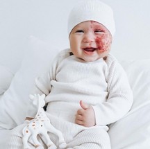 O bebê australiano passou por um tratamento a laser na pele com apenas cinco meses de idade — Foto: Reprodução