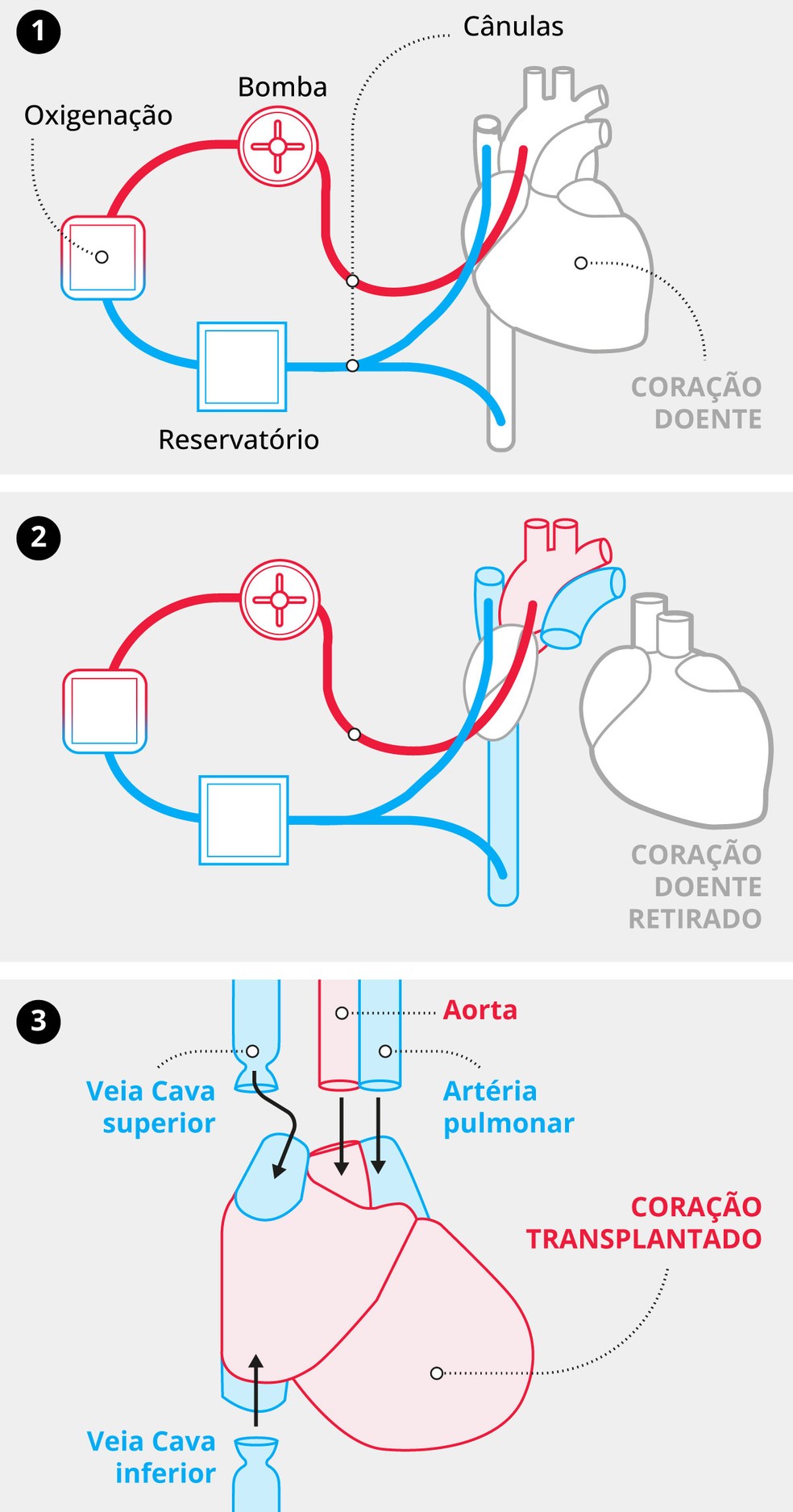 Etapas da cirurgia do transplante de coração — Foto: Arte GLOBO