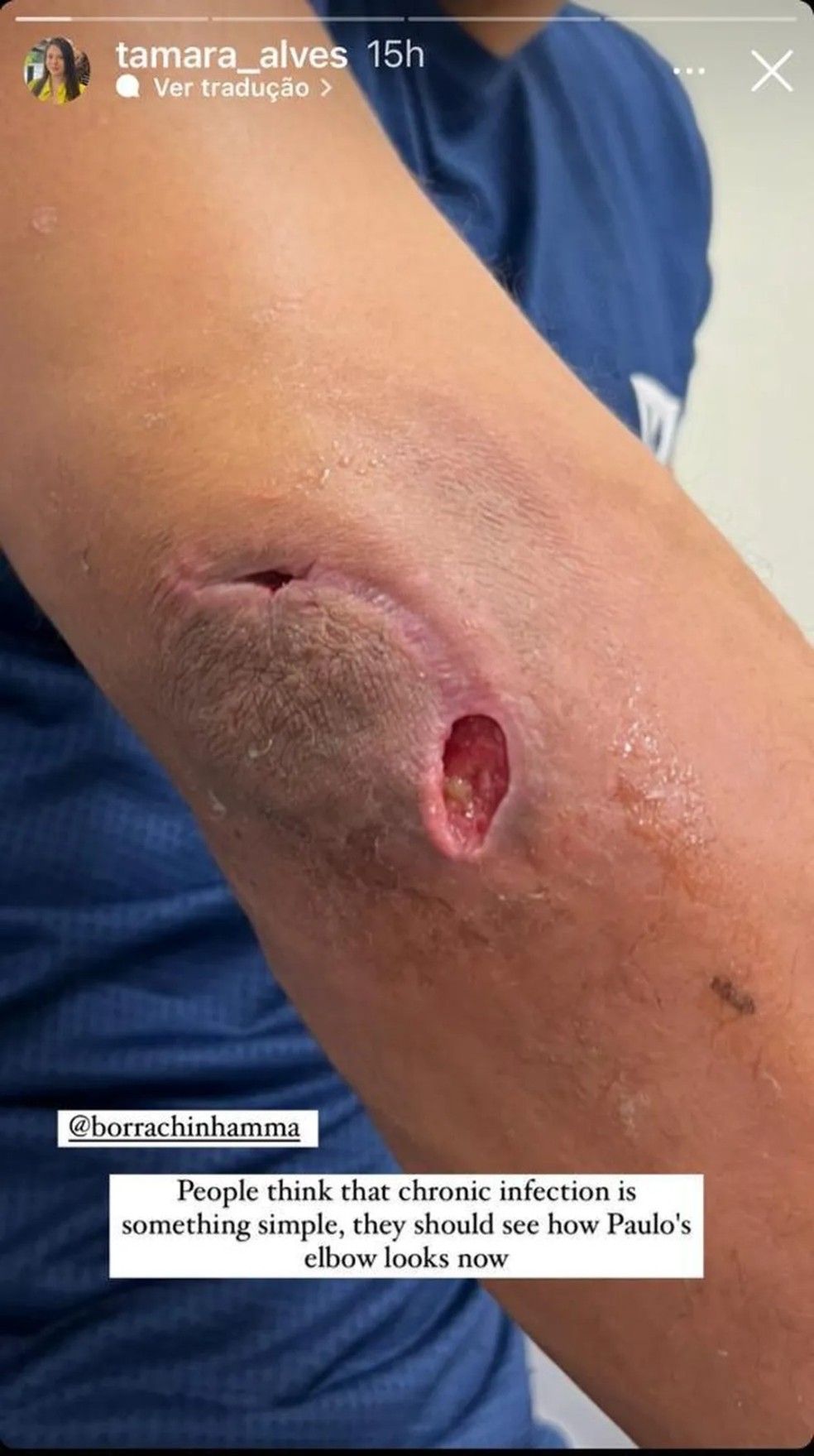 Imagem que mostra a infecção do lutador foi compartilhada pela namorada Tamara Alves — Foto: Reprodução / Redes Sociais