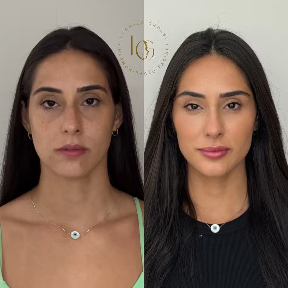 Deniziane fez harmonização facial após deixar o reality