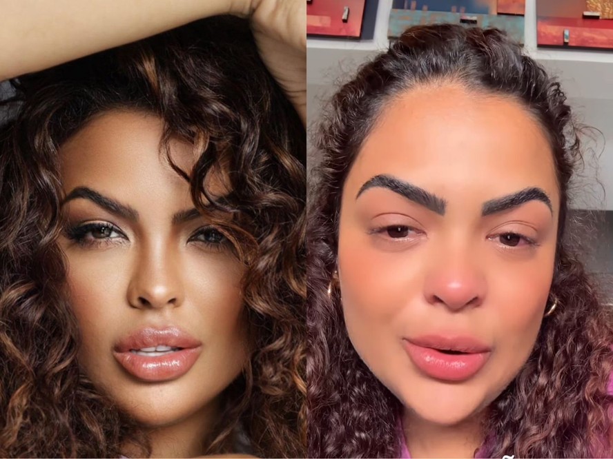 Paula no antes e depois da remoção do preenchimento labial