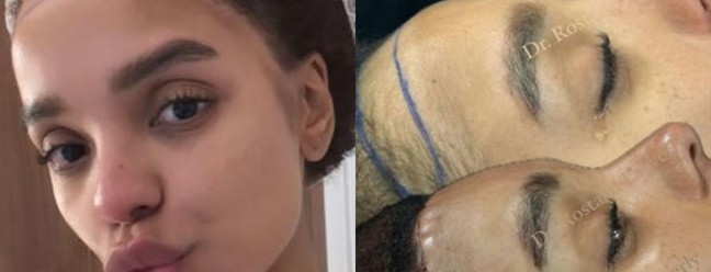 Brunna Gonçalves passou por cirurgia para diminuir a testa — Foto: Reprodução Instagram
