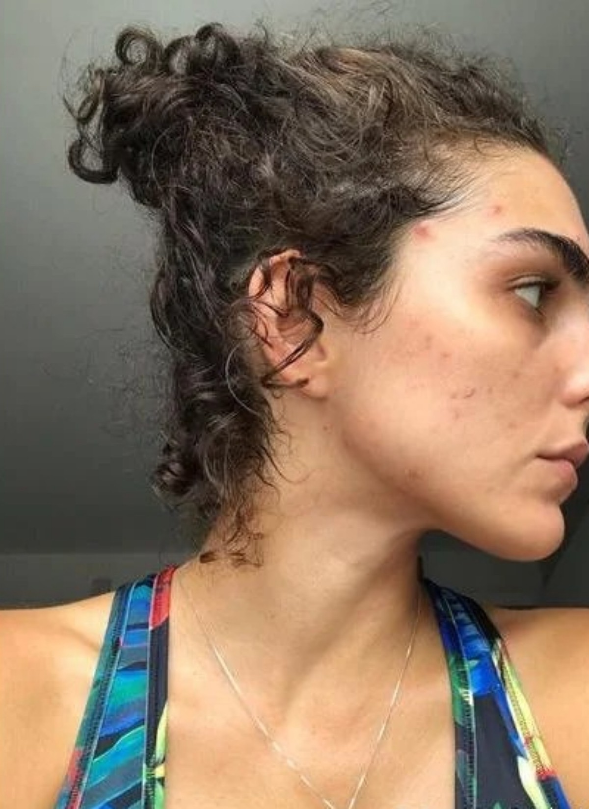 Julia Konrad já enfrentou problema com acne — Foto: Reprodução Instagram