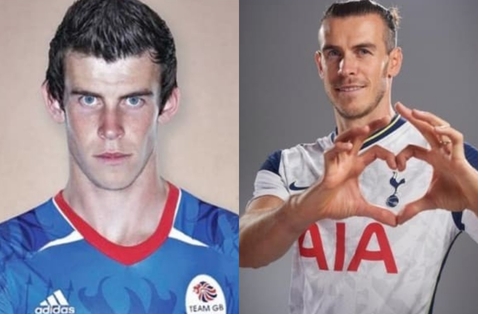 Otoplastia: antes e depois do jogador de futebol Gareth Bale