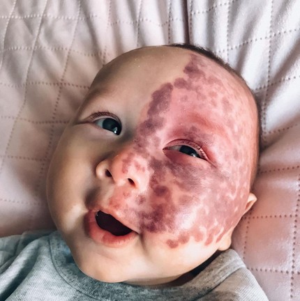 Nascido em fevereiro de 2022, Kingsley Colvin nasceu com condição rara chamada síndrome de Sturge-Weber — Foto: Reprodução