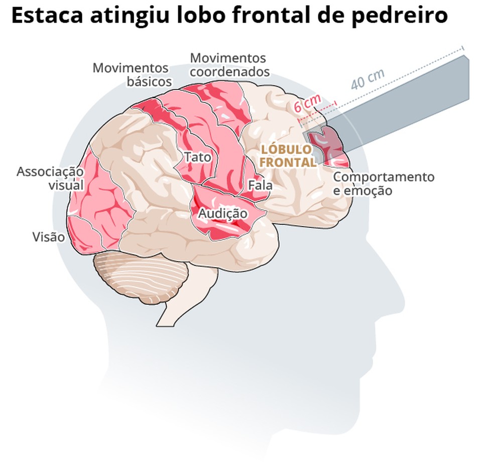 Estaca atinge lobo frontal do pedreiro Vitor Soares do Nascimento — Foto: Editoria de Arte