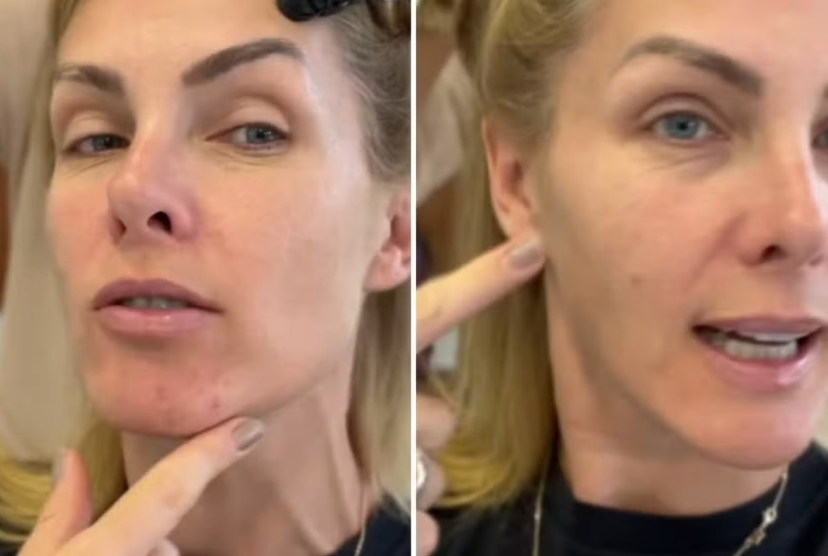 Ana Hickmann já enfrentou problema com acne — Foto: Reprodução Instagram