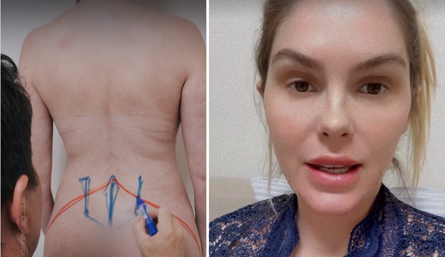 Bárbara Evans, de 33 anos, revela ter silicone no glúteo e que aproveitou as intervenções para 'empinar o bumbum'